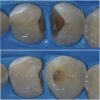 Bulk Fill Seringue
