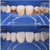Coffret résine composite Micro hybride