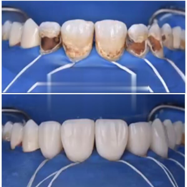 Coffret résine composite Micro hybride