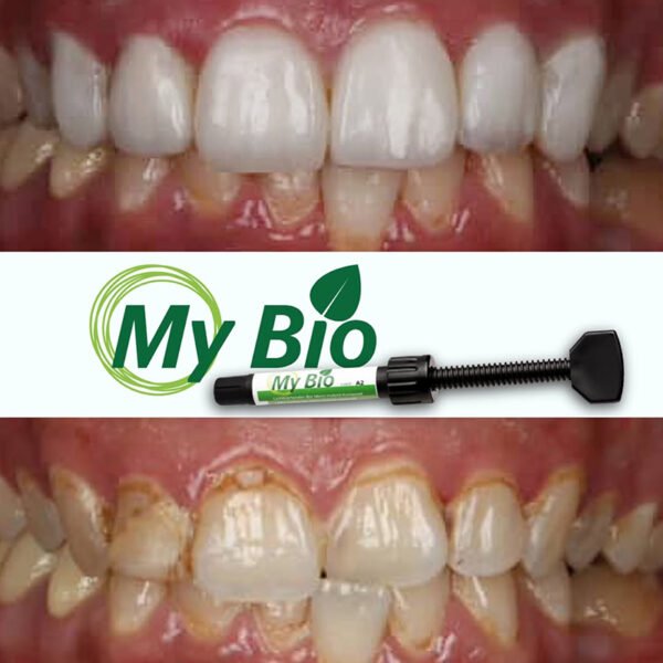 Résine Composite Bio