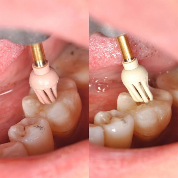 oCCLUFLEX Diacomp Plus OCCLUFLEX Mix